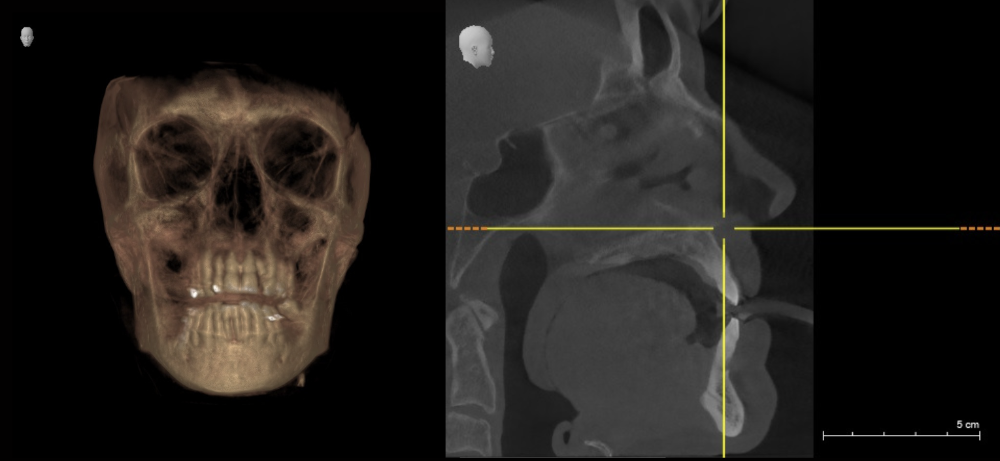 CBCT machine scans