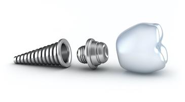 dental implant in Darwin