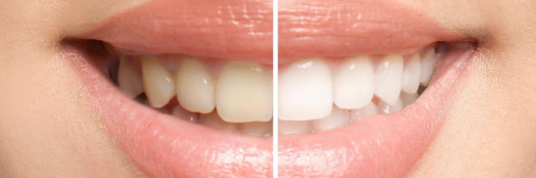 before and after teeth whitening