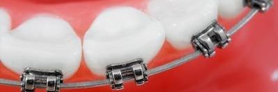 close up of braces on teeth