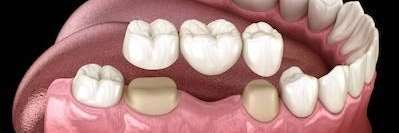 dental bridge in mesquite