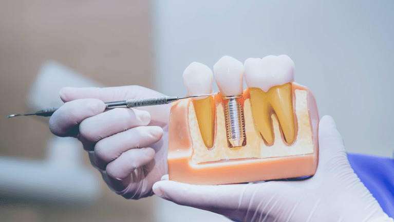 dentist showing the structure of dental implant in Casuarina NT