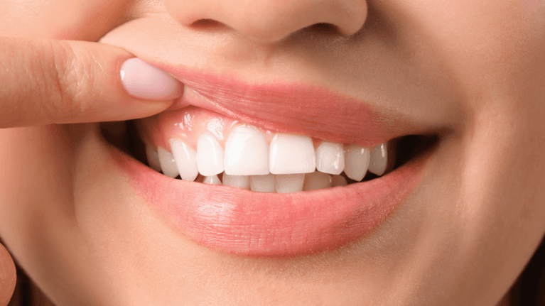 tooth bonding in casuarina