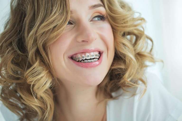 A woman wearing braces in Casuarina