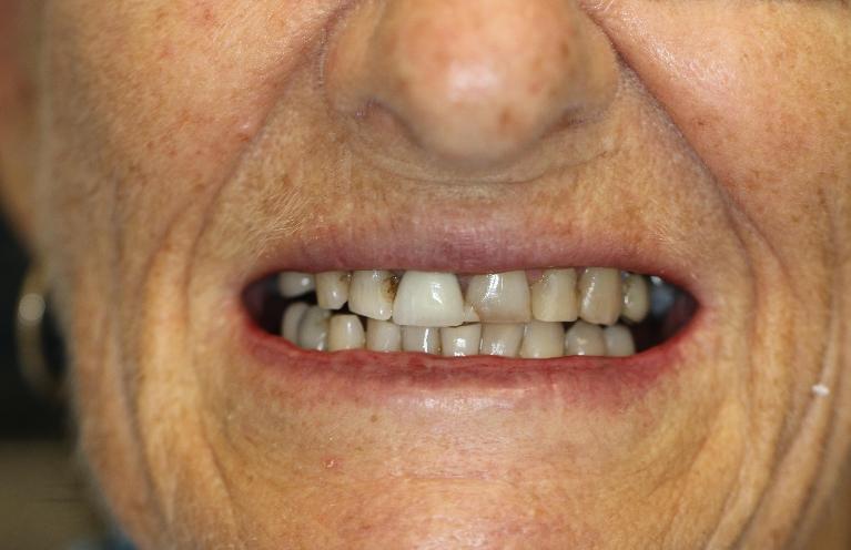 Veneers-Before-Image